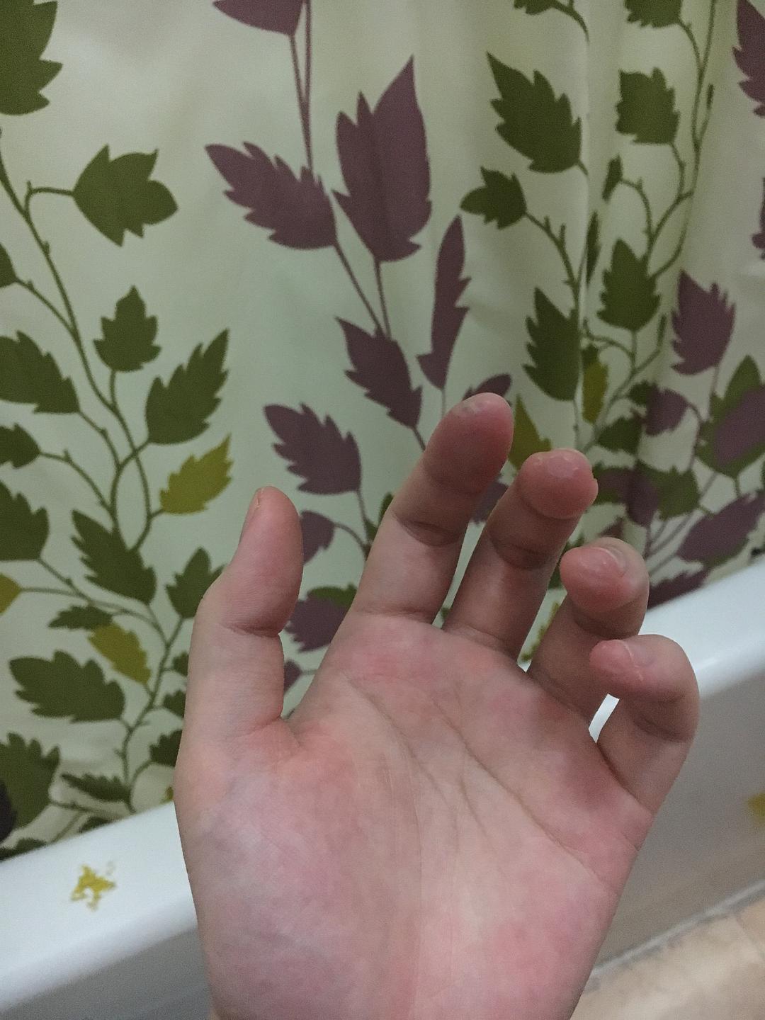 食指和中指之间有老茧怎么办_玩手机游戏食指中指起茧_食指中指之间长茧