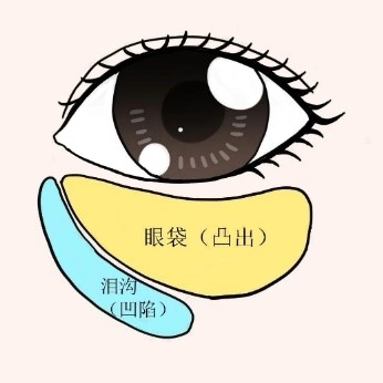 玩手机游戏会有眼袋吗吗_眼袋玩手机游戏会有危害吗_玩手机眼袋能加重吗