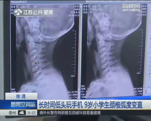 玩游戏对颈椎,揭秘长时间游戏对颈椎的潜在危害”(图1) 玩游戏对颈椎,揭秘长时间游戏对颈椎的潜在危害”(图1)