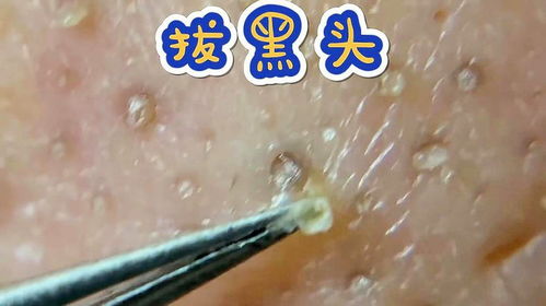 拔黑头游戏,拔黑头游戏大揭秘(图2) 拔黑头游戏,拔黑头游戏大揭秘(图2)