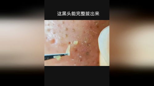 拔黑头游戏,拔黑头游戏大揭秘(图3) 拔黑头游戏,拔黑头游戏大揭秘(图3)