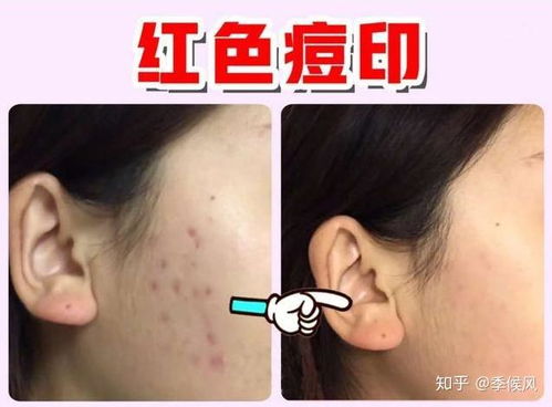 游戏去痘痘,探索去痘痘的神奇游戏疗法(图1) 游戏去痘痘,探索去痘痘的神奇游戏疗法(图1)