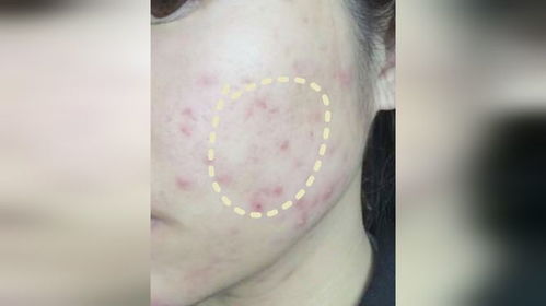 游戏去痘痘,探索去痘痘的神奇游戏疗法(图3) 游戏去痘痘,探索去痘痘的神奇游戏疗法(图3)